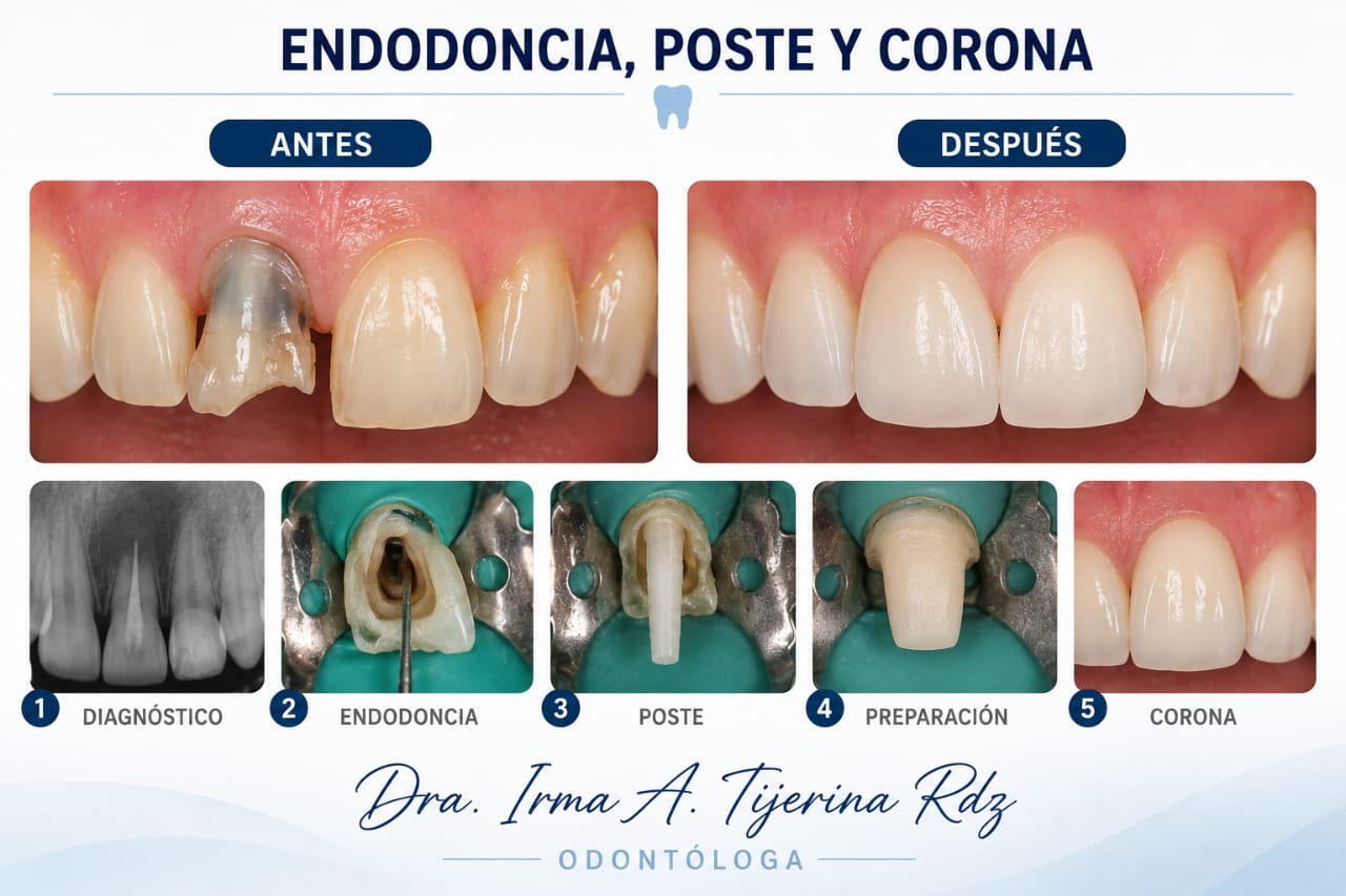 Endodoncia, poste y corona